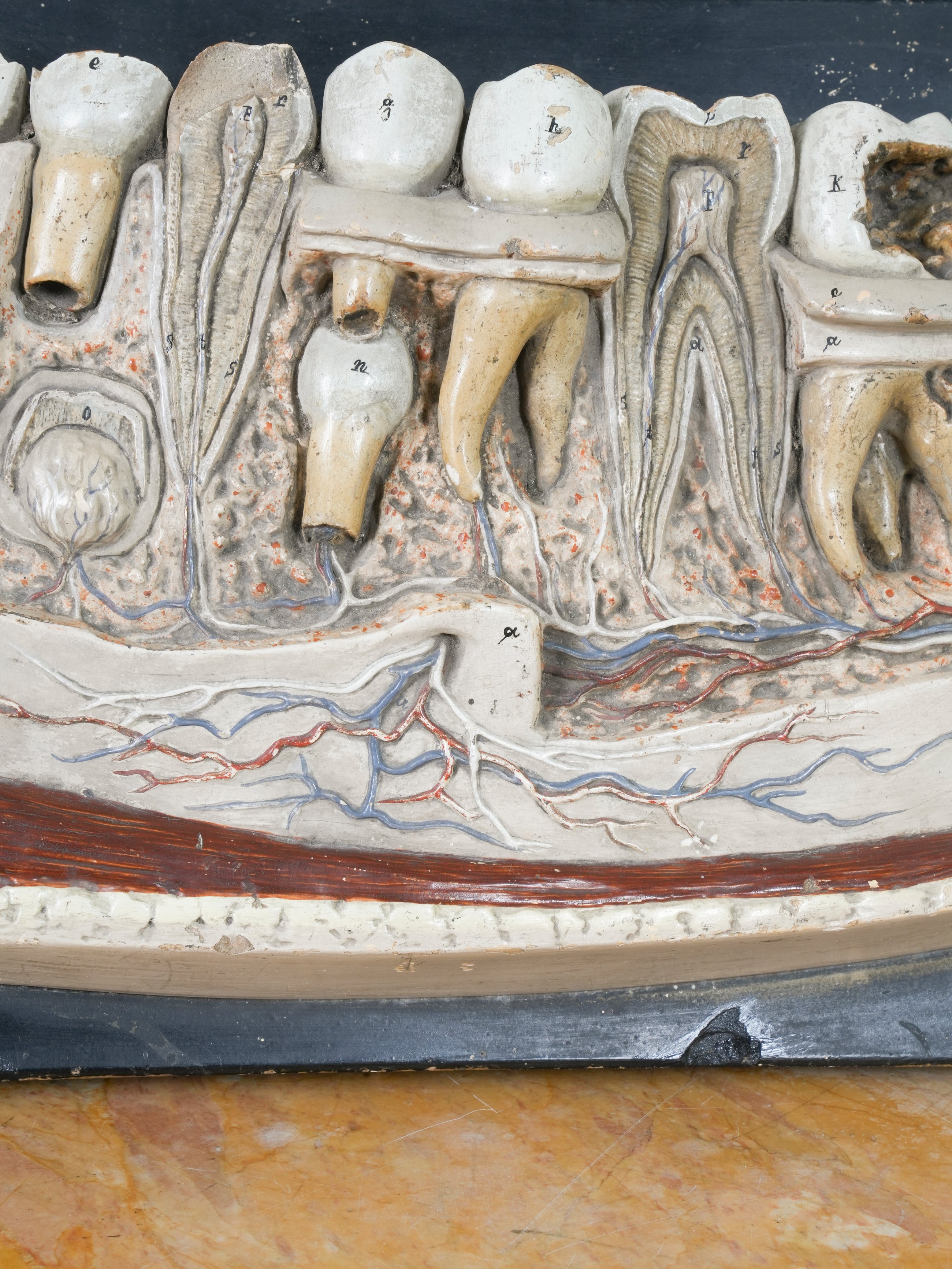 A 19th Century Plaster Didactic Model of Malformed Teeth